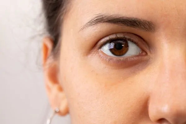 Augenringe: Was wirklich gegen die dunklen Ränder unter den Augen hilft